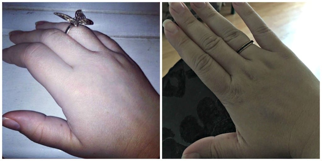 hands with arthritis comparison